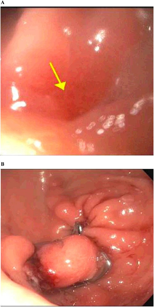 Gastrointestinal endoscopy. (A) Fistula defect found in the gastric antrum. (B) After endoscopic closure of the fistula using the over-the-scope clip system.