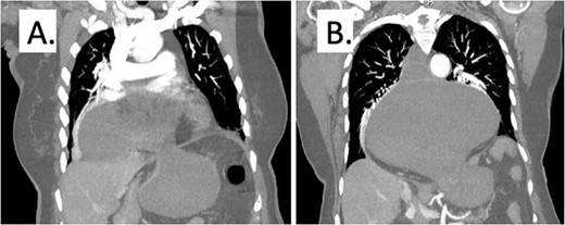 Representative computed tomography image demonstrating gastric distention and area of volvulus (A) and extent of hiatal hernia (B).