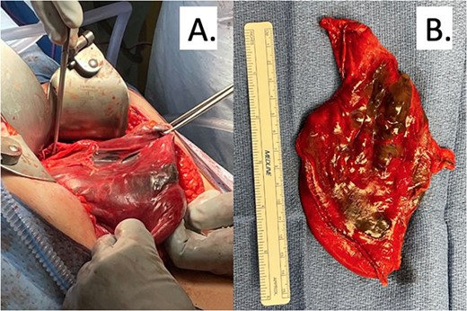 (A) Intraoperative findings of patchy gastric necrosis along greater curvature. (B) Partial gastrectomy specimen with necrotic areas spanning across 10 cm.