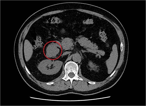 Transversal abdominal CT scan revealing a retroperitoneal polylobate neoformation in the right perirenal space.