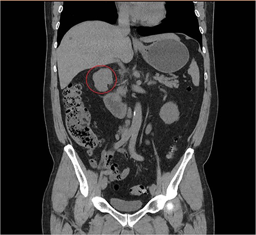 Coronal abdominal CT scan revealing a retroperitoneal polylobate neoformation near the duodenum.