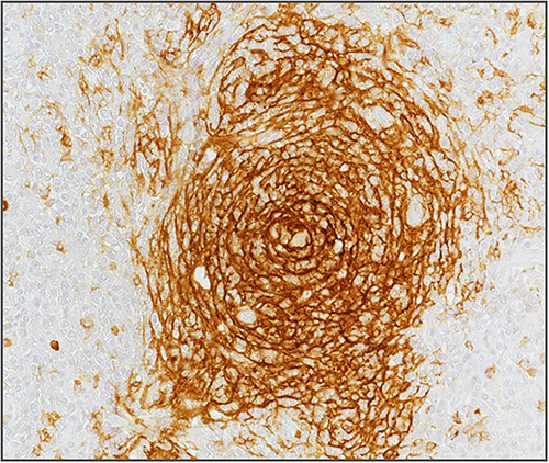 Hyperplasia of follicular dendritic cells (staining of follicular dendritic cells with anti-CD21 antibody).
