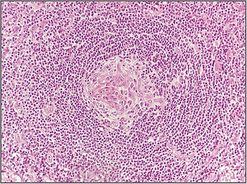 Dysplasia of follicular dendritic cells.