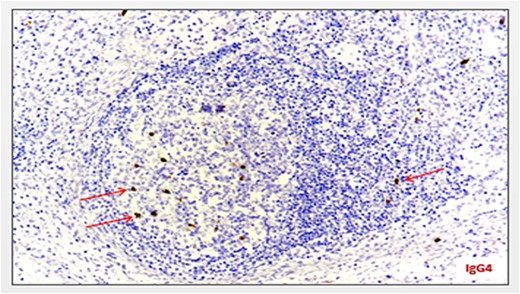 Minimum amount of IgG4-secreting plasma cells (staining with anti-IgG4 antibody) (arrows).