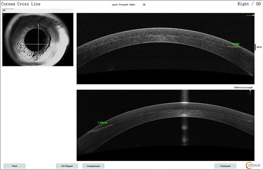 AS-OCT signs for the right eye on the first postoperative day.