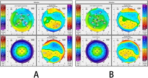 Corneal topography after enhancement surgery: (A) first postoperative day; (B) fifth postoperative day.
