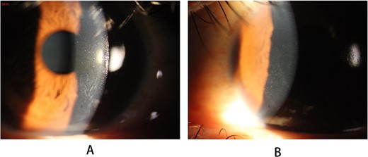 Slit-lamp photography of the lesions on the 13th postoperative day: (A) right eye; (B) left eye.