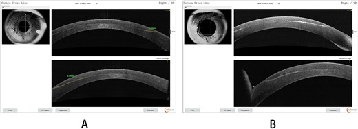 (A) AS-OCT signs for the right eye on the fifth day; (B) a detailed shot of the nasal inferior quadrant region.