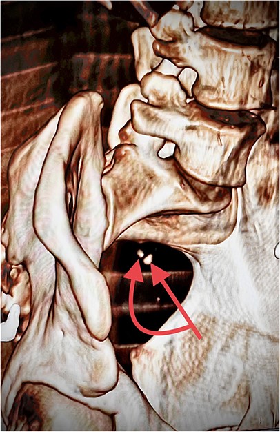 Image of a 3D computed tomography reconstruction distinctly revealing two separate stercoliths, each located at a different site and oriented differently, thereby reinforcing the suspicion of appendiceal duplication.