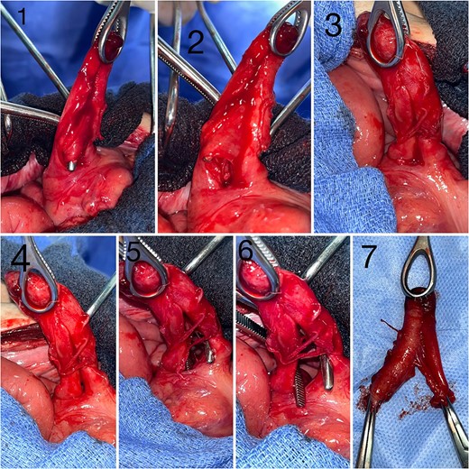 Intraoperative images depicting appendiceal duplication, 1 and 2: Images showing the two appendices, sharing a common mesentery, with two distinct bases and a common tip, 3 and 4: Images of the two appendices prior to dissection, 5 and 6: Images following the separation of the two appendices, 7: Surgical specimen.