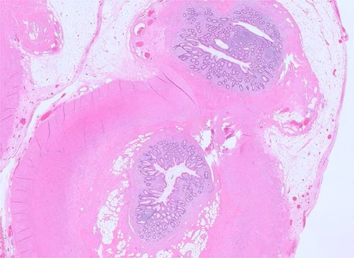 Microscopic examination of the specimen reveals two appendices with two separate lumens, partially sharing the muscularis layer, the sub-serosa, and the serosa (H&E, ×100).