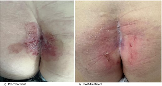 (a) Clinical photograph of patient’s natal cleft demonstrating broad region of excoriation with plaques, central sinus at superior aspect of the cleft, and prior coccygectomy scar in the left paramedian position. (b) Clinical photograph of patient’s natal cleft post-radiotherapy showing significant reduction of skin excoriation and plaque sizes and obliteration of the sinus tract.