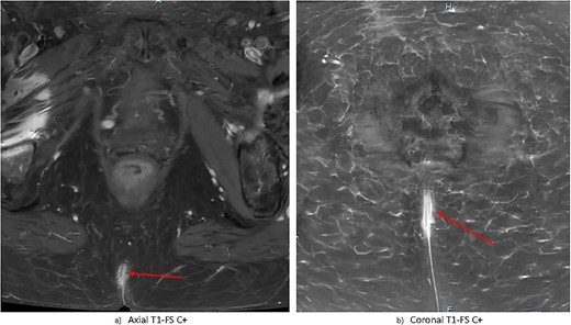 Gadolinium-contrast enhanced MRI images at time of diagnosis showing small-volume, superficial disease in (a) axial and (b) coronal planes. There is evidence of nonspecific superficial skin enhancement (arrows) but no evidence of significantly infiltrative disease or nodal metastases.