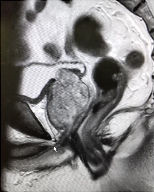 Magnetic resonance imaging before surgery showing BPH with middle lobe hypertrophy.