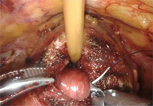 Puncture of the middle-lobe using a 25-cm, 26-mm, 3–0 monofilament needle.