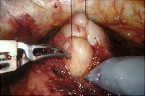 Grasping of the thread with the fourth arm followed by lifting.