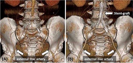 (A) Pre-operative contrast-enhanced CT reveals bilateral CIA occlusion from the abdominal aorta, with bilateral EIA stenosis, without calcification. (B) Contrast-enhanced CT 8 months post-surgery shows good bilateral EIA dilatation.