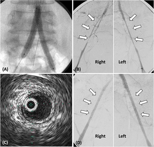 (A) Stent grafts placed from the abdominal aorta to bilateral CIA using the kissing stent technique. (B). Stenosis observed in both EIA, treated with plain balloon angioplasty only. (C) Post-balloon dilatation intravascular ultrasound reveals the absence of calcification or atheroma in both EIA. (D) Angiography post-balloon dilation reveals no EIA stenosis and calcification or atheroma.