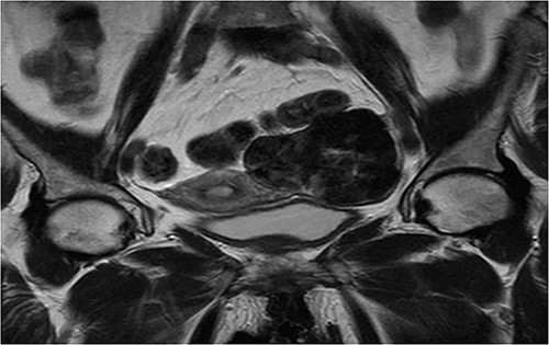 Coronal T2 sequence: left uterine mass, heterogeneous, in T2 hyposignal containing areas in hypersignal.
