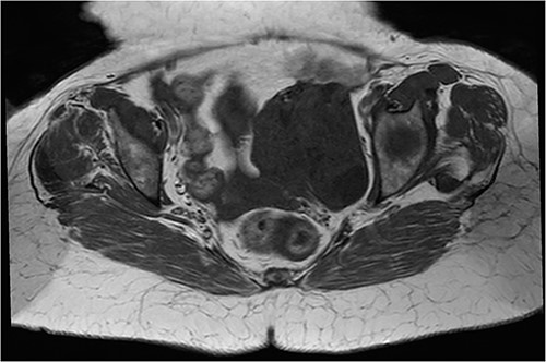 Axial T1 sequence: bulky left uterine mass with T1 hyposignal.