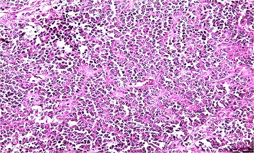 HE section showing diffuse sheets of small, closely packed round cells with scant cytoplasm separated by fibrous septa (x200).