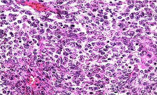 HE section of small monomorphic tumor cells showing hyperchromasia and mitotic figures (x400).