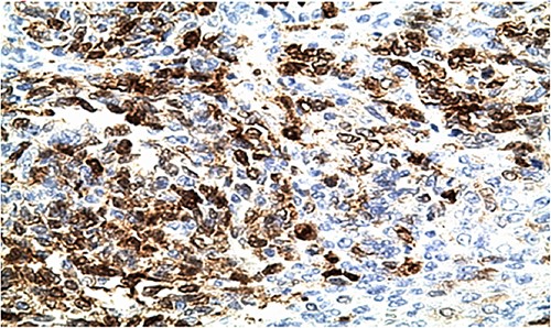 IHC: tumor cells show a nuclear strong expression of p16 (x400).