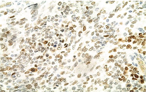 IHC: patchy nuclear expression of SALL4 by tumor cells (x400).