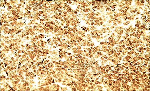 IHC: diffuse nuclear staining of WT1 by tumor cells (x400).