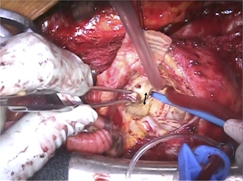 Intraoperative view of previous Bentall procedure. The arrow indicates the thickened aortic wall of the left coronary ostium due to the chronic dissection.