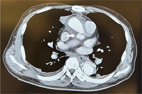 Computed tomography scans revealed a pseudoaneurysm from the left coronary artery. The arrow indicates the pseudoaneurysm.