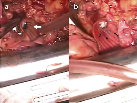 Intraoperative view of reoperation. The arrow indicates the dehiscence in the 6–9 o’clock thread of the left coronary button (a). The arrow indicates the loose thread (b).