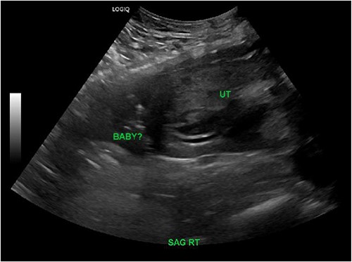 Right sagittal view on transvaginal ultrasound showing an empty uterine cavity with possible fetus outside of the uterus.