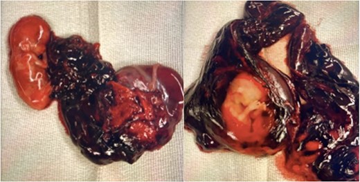 Fetus A (left) with grossly normal phenotype with attachment to the placenta. Fetus B (right) with grossly normal phenotype and intact amniotic membranes.