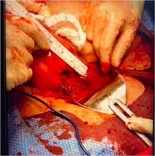 Two-centimeter complete uterine rupture site on the anterior lower uterine segment, likely at the site of prior hysterotomy.