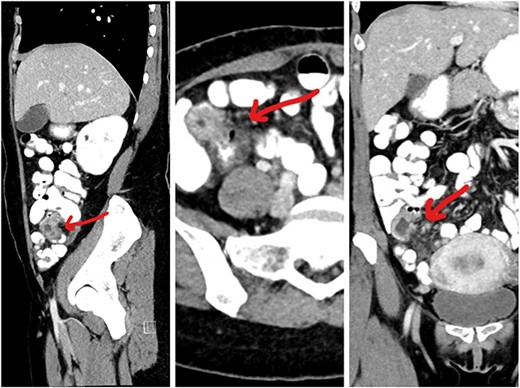 CT images showing the lesion in the right iliac fossa.