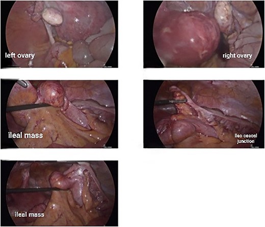 Intraoperative laparoscopic pictures showing normal uterus, ovaries, and the ileal lesion.