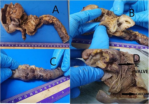 (A) Received partially cut opened limited hemicolectomy specimen. Ileum measuring 17 cm in length, 2 cm in diameter. Caecum dilated measuring 7.5 × 4.5 × 0.5 cm. Appendix identified measuring 4.0 × 0.4 cm. (B) Ileum shows already cut opened mass measuring 2.5 × 2.0 × 1.0 cm. Protruding into lumen. Cut surface showing cystic change with mucoid material. (C) Ileal end shows stricture for length 5 cm with serosa showing reddish hemorrhagic spots. (D) Ileocaecal valve shows congestion with brownish area. Caecum dilated wall thinned out with loss of mucosal rugosity. Representative sections submitted.