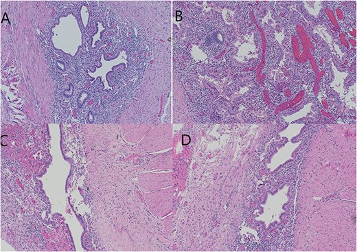(A, B) Ileum with cystic structure showing submucosal endometrial glands and stroma plus hemosiderin extending to deeper layers of intestine surrounded by smooth muscle layer. (B) Ovarian tissue with diffuse areas of hemorrhage and necrosis. (C, D) Multiple mural and serosal foci of endometriosis noted corresponding to area of ileal stricture.