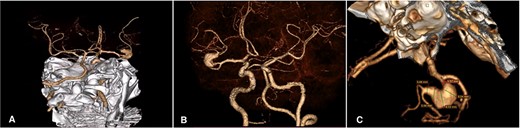 Cerebral Angiotomography. (A) Posterior view depicts an unruptured giant fusiform aneurysm in the M2 segment of the right MCA; (B) Anterior view reveals a close aneurysm proximity to the M1 segment of 3 mm; (C) Complex architecture of the giant fusiform aneurysm is shown with adjacent M2 and M3 branches. MCA: middle cerebral artery