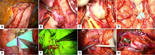 Intraoperative Course. (A) Harvesting of the STA; (B) Distal dissection of the Sylvian fissure to expose the M2 segment; (C) Proximal dissection of the Sylvian fissure exposed the M1 segment, M2 bifurcation and the giant fusiform aneurysm; (D) and (E) M3 segment arteriotomy and end-to-side anastomosis between the STA and MCA; (F) and (G) Intraoperative fluorescein imaging and Doppler utilization to corroborate bypass patency; (H) Permanent clipping and exclusion of the giant fusiform aneurysm of the superior M2 segment. MCA: middle cerebral artery, STA: superficial temporal artery.