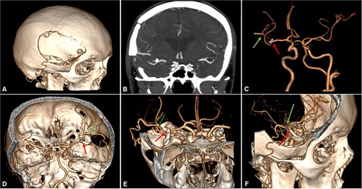 Postoperative Imaging. (A) 3-Dimensional image reconstruction shows the craniotomy with the entrance of the STA into the skull; (B) Coronal view of a maximum intensity projected multislice spiral CT shows the permanent clip placed with the exclusion of the fusiform aneurysm; (C)–(F) Cranial views depict patency of the STA-MCA bypass (green arrow) and clipping of the M2 proximal segment (red arrow). CT: computed tomography, MCA: middle cerebral artery, STA: superficial temporal artery.