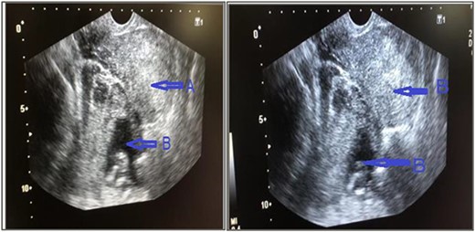 Trans vaginal ultrasound was done that showed, (a) empty uterine cavity, with no gestational sac, (b) live fetus of 14 weeks 6 days in left adnexa and moderate amount of free fluid in pelvis.