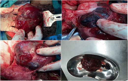 Ectopic pregnancy at the left adnexa, extending to occupy the left broad ligament, left ovary was attached on it but dissectable, size ~10.8 cm, placenta and sac together.