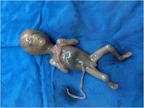 A 150 gms dead fetus of broad ligament pregnancy.