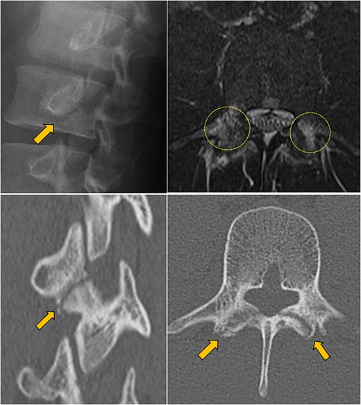 Preoperative lumbar X-ray, MRI, and CT scan; upper left: oblique view X-ray showed a complete fracture line (arrow); upper right: horizontal T2-weighted MRI showed a high signal area in the pedicles bilaterally (circles); lower left, right: oblique and horizontal CT scan showed a complete fracture line in the pars (arrow).