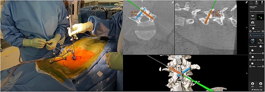 Screw planning; the appropriate screw length and angle were displayed on navigation monitor (right panel).