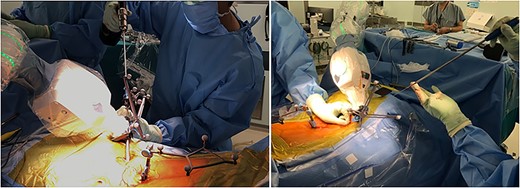 Making screw hole using a power drill with robotic arm (left panel); insertion of screw via a guidewire (right panel).