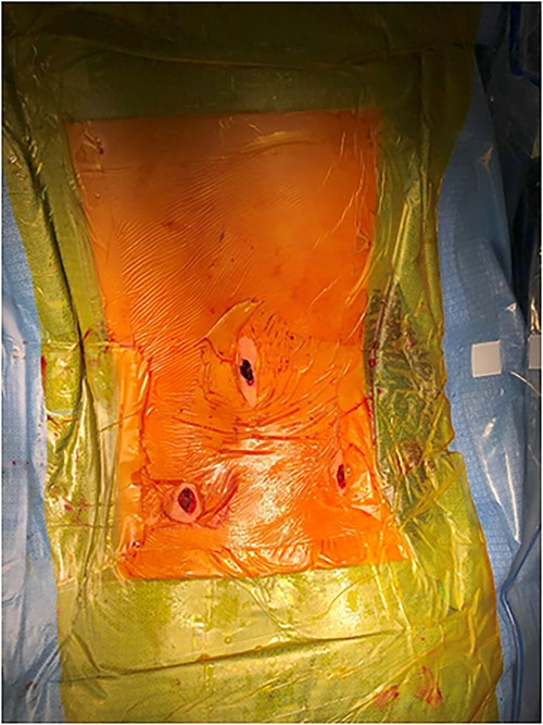 Three small surgical wounds.