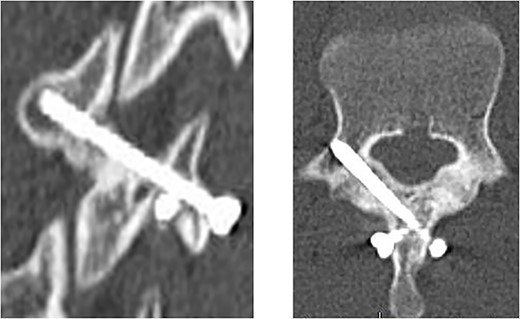 CT scan at 2 months after surgery; oblique view (left panel) and horizontal view (right panel).